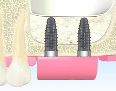サイナスリフト