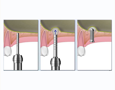 ソケットリフト