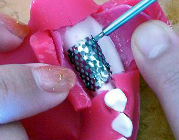 チタンメッシュ骨造成